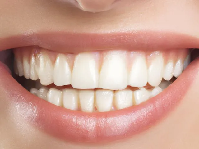 Laser Teeth Whitening